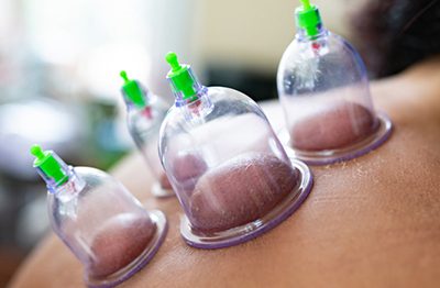 Hijama Cupping Therapy 